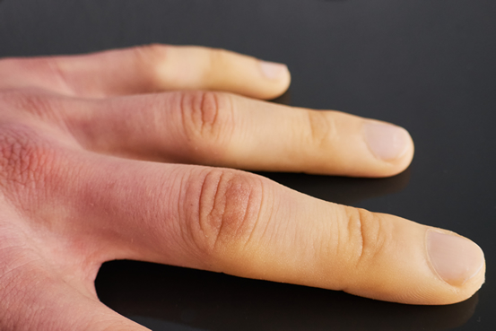 Fenómeno de Raynaud, Síndrome ou Doença de Raynaud